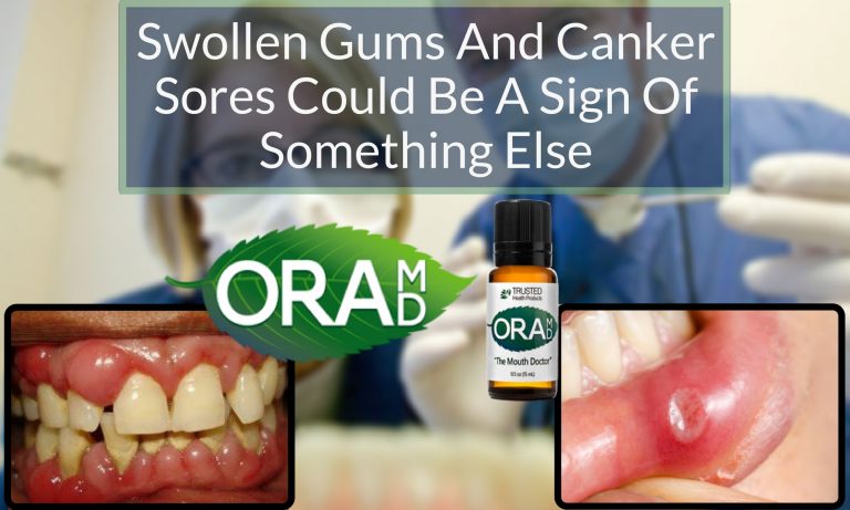 swollen-gums-and-canker-sores-could-be-a-sign-of-something-else-oramd