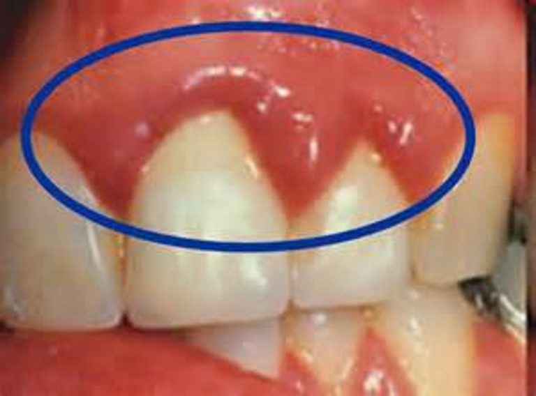 Gum Infection What It Is And How To Treat It OraMD