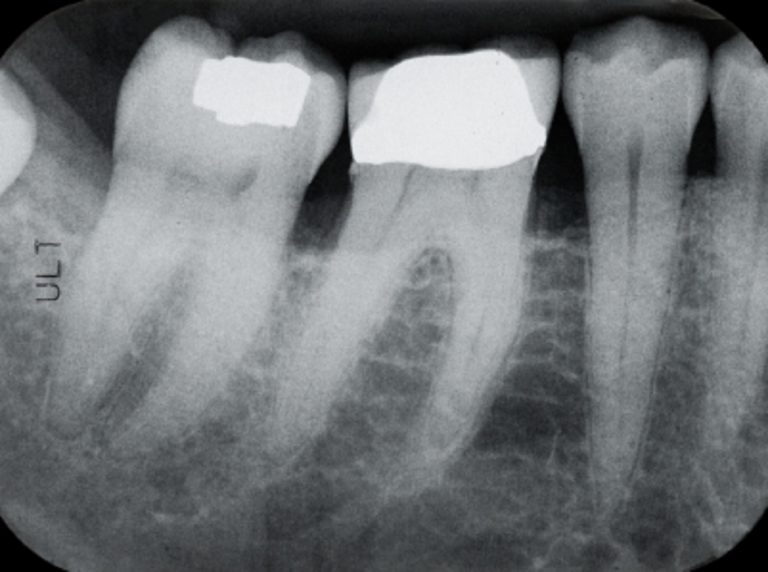 loose-teeth-treatment-and-what-the-causes-are-oramd